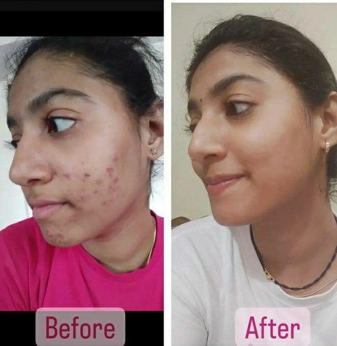 Best Kojic Acid Soap For Hyperpigmentation Review 2023 best-kojic-acid-soap-for-hyperpigmentation-review-2023